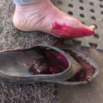 Toe meets axe
